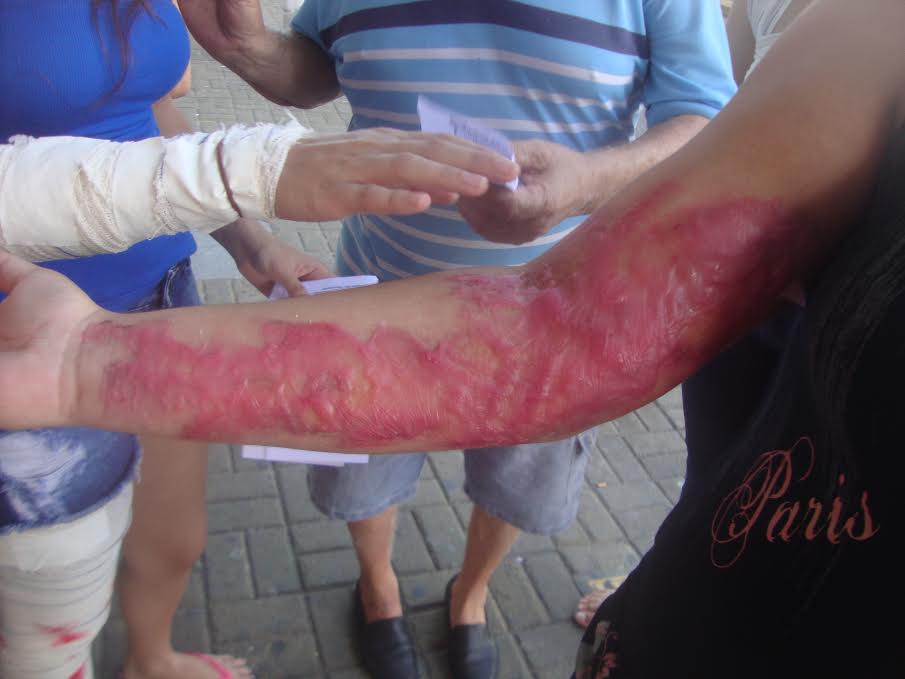 Hospital Walfredo Gurgel ensina técnicas de combate a&nbsp;queimadura