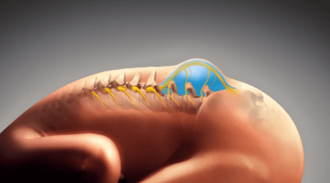 ISD e Neurinho realizam atividades em alusão ao Dia Internacional da Espinha Bífida e&nbsp;Hidrocefalia