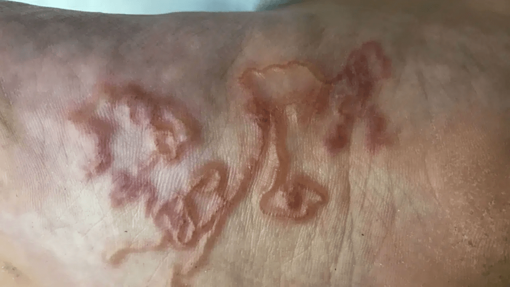 Dermatologista orienta sobre a prevenção do bicho-geográfico; larva penetra a pele e pode provocar lesões com&nbsp;coceira